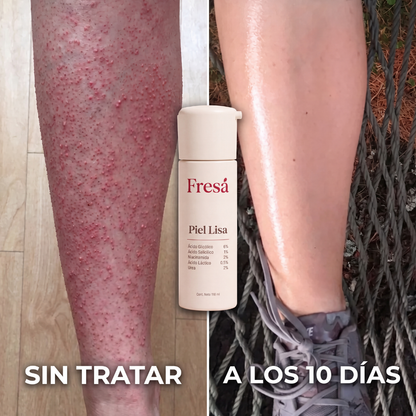 Fresá — Tratamiento Triple Ácido para Piel de Frutilla