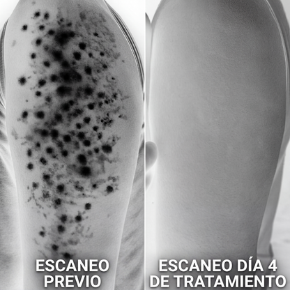 Fresá — Tratamiento Triple Ácido para Piel de Frutilla